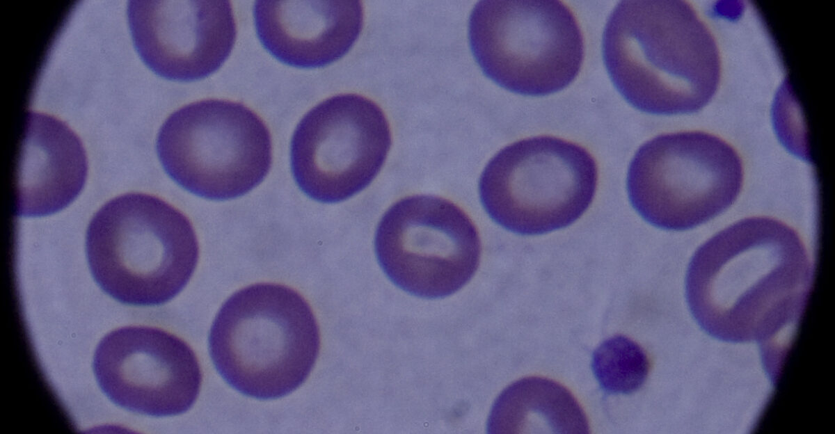 Red and white blood cells are shown through a microscope March 4 at the 354th Medical Group laboratory at Eielson Air Force Base Alaska The cells are magnified 100 times making it easier for a lab technician to count the white blood cells for signs of infection