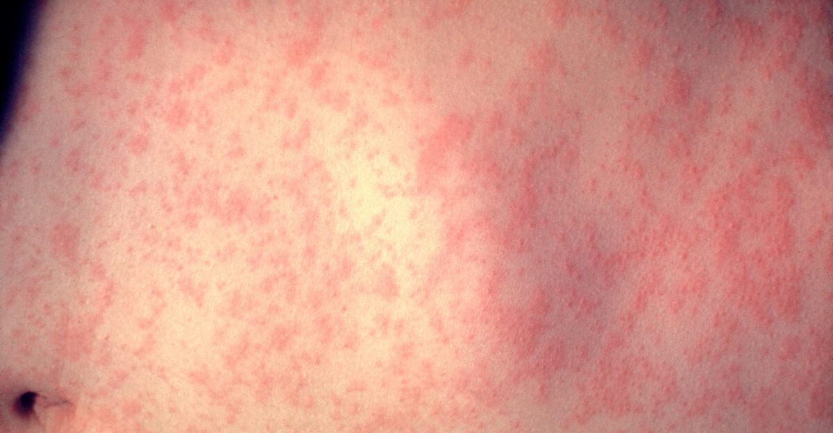 This is the skin of a patient after 3 days of measles infection treated at the New York - Presbyterian Hospital Prior to widespread immunization measles was common in childhood with more than 90 of infants and children infected by age 12 Recently fewer than 1 000 measles cases have been reported annually since 1993